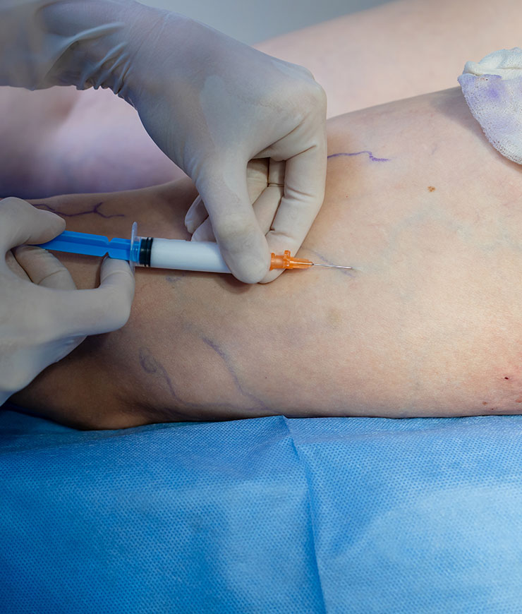 Sclerotherapy